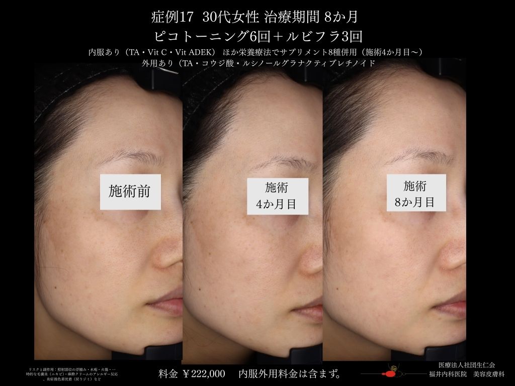 ピコレーザー症例_vol.17_004