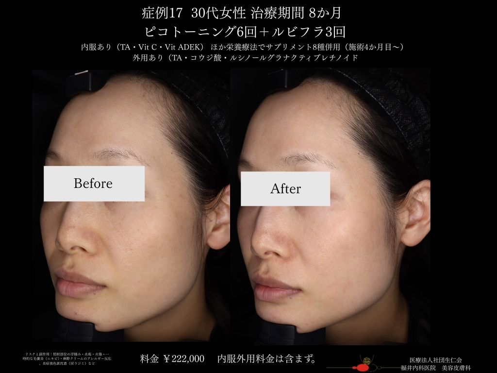 ピコレーザー症例_vol.17_005