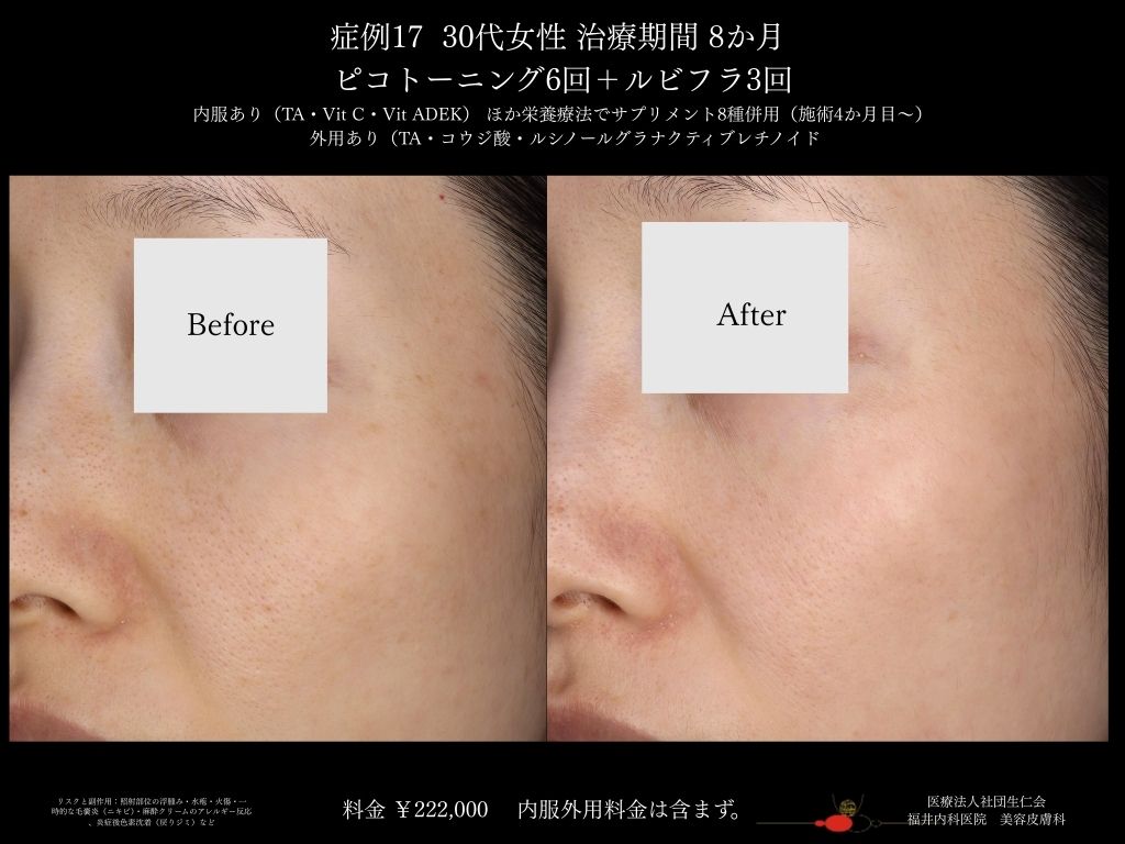 ピコレーザー症例_vol.17_006