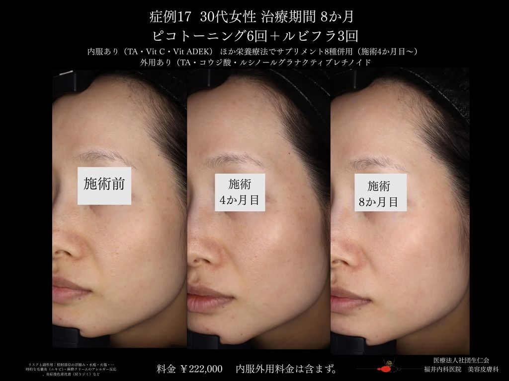ピコレーザー症例_vol.17_007