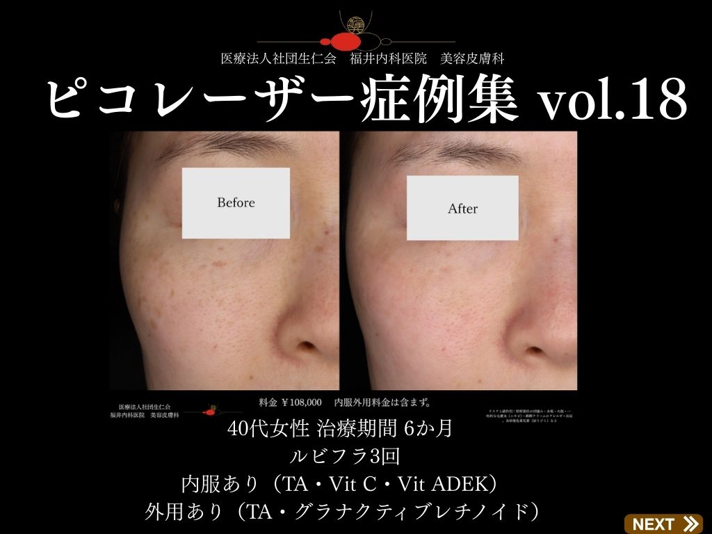 ピコレーザー症例_vol.18_001