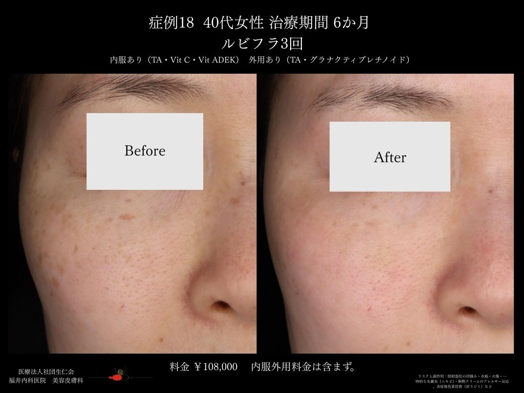 ピコレーザー症例_vol.18_002