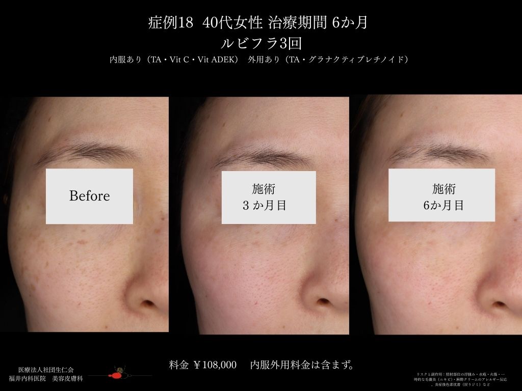 ピコレーザー症例_vol.18_003