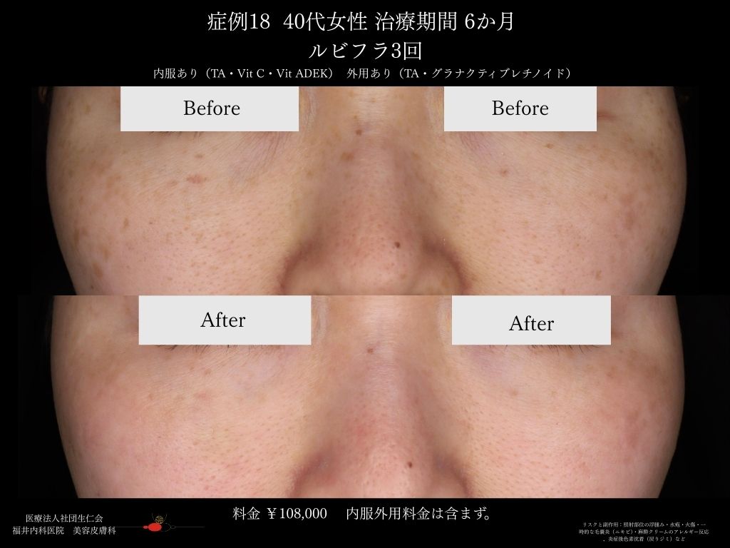 ピコレーザー症例_vol.18_004