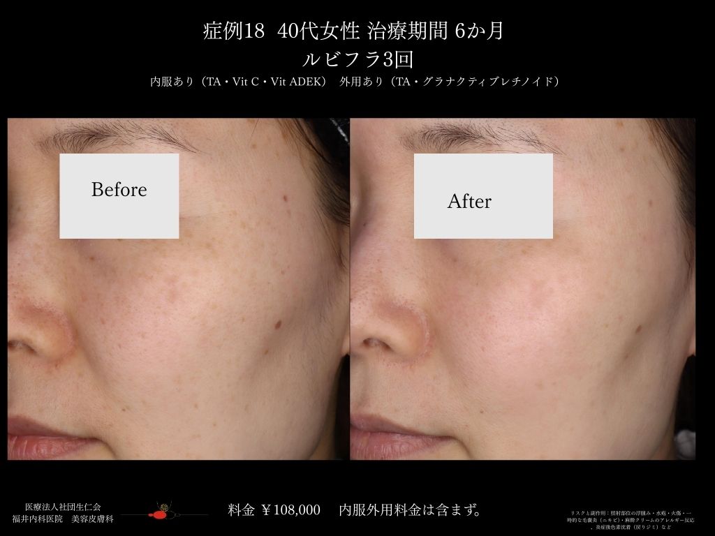 ピコレーザー症例_vol.18_005