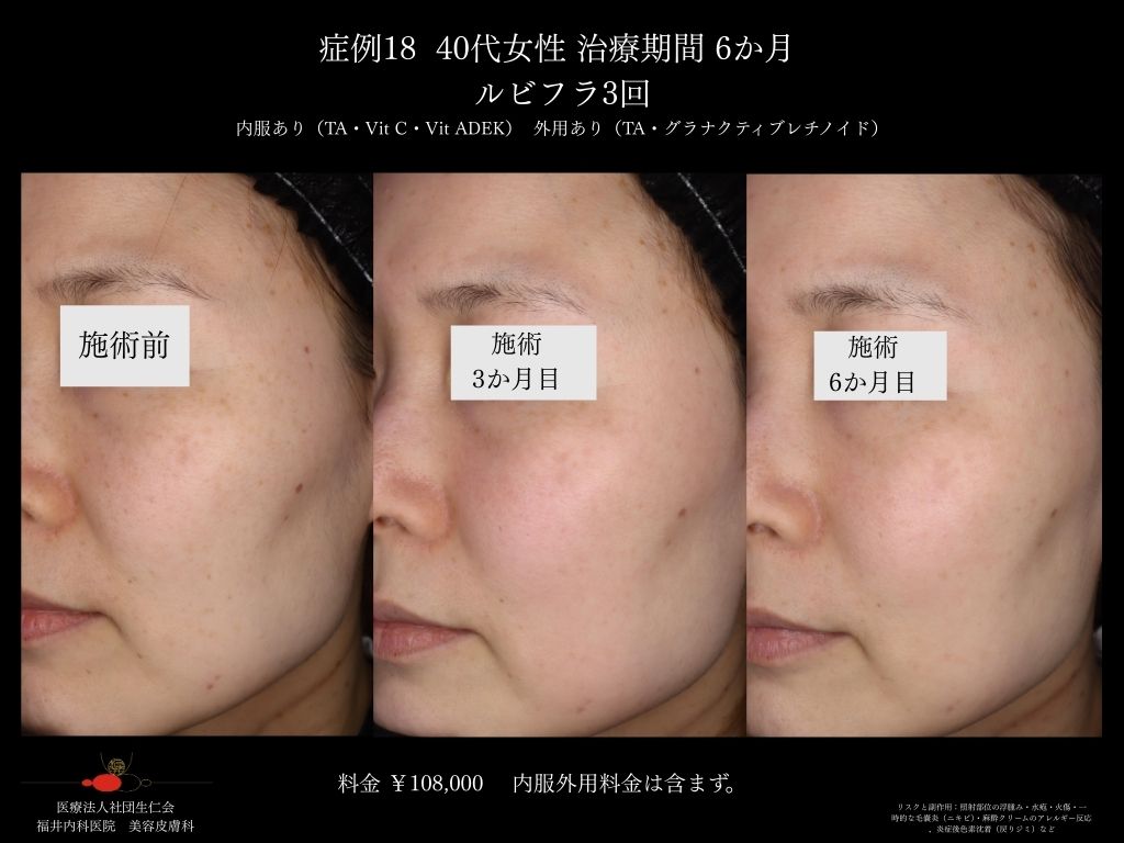 ピコレーザー症例_vol.18_006