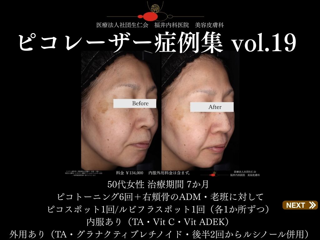 ピコレーザー症例_vol.19_001