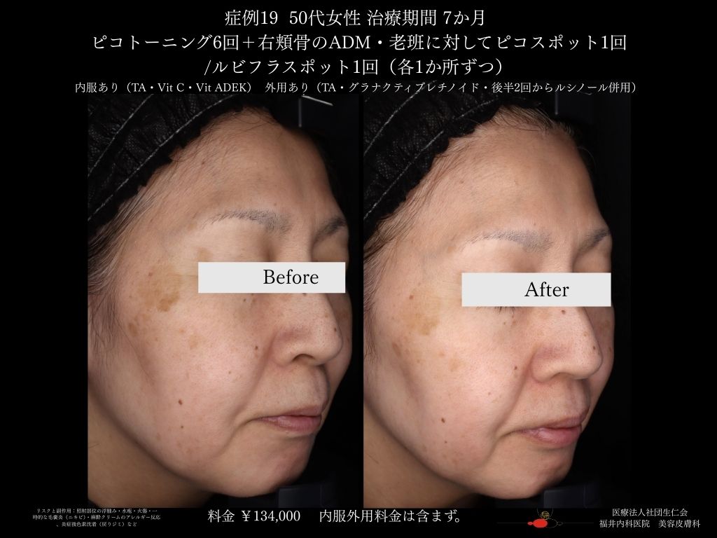 ピコレーザー症例_vol.19_002
