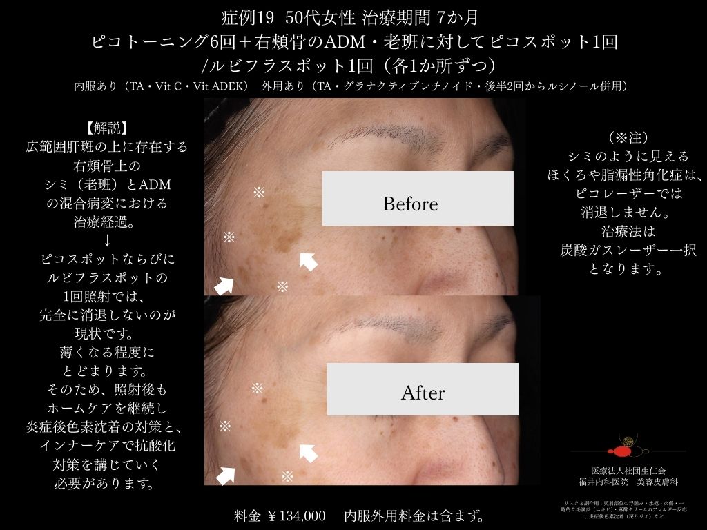ピコレーザー症例_vol.19_003
