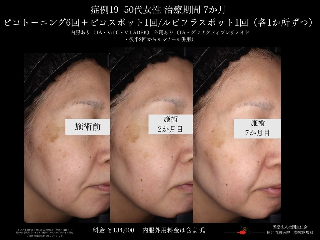 ピコレーザー症例_vol.19_004