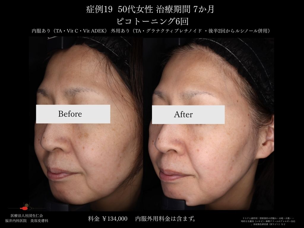 ピコレーザー症例_vol.19_005