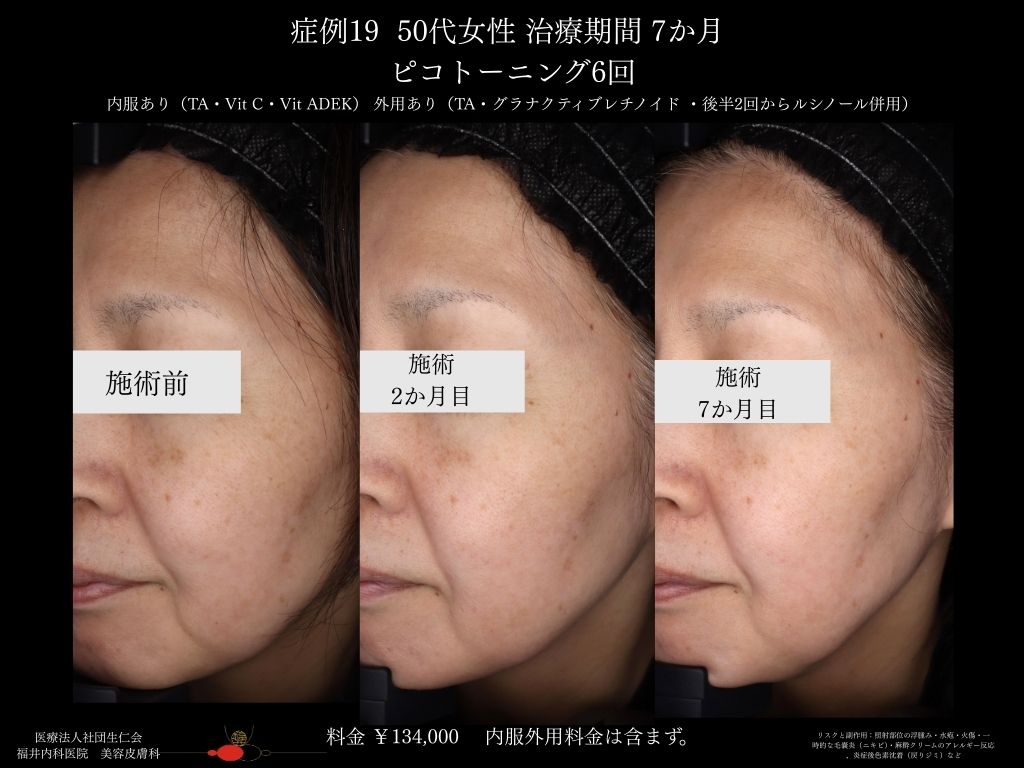 ピコレーザー症例_vol.19_006