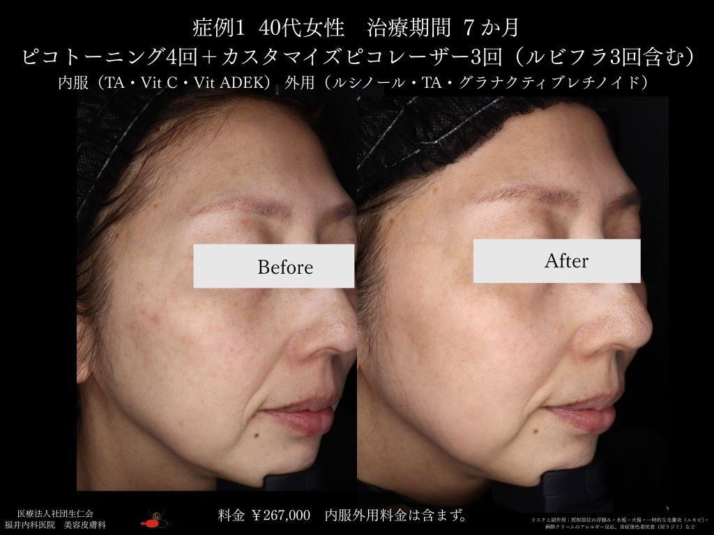 ピコレーザー症例_vol.1_002