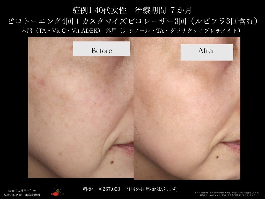 ピコレーザー症例_vol.1_003