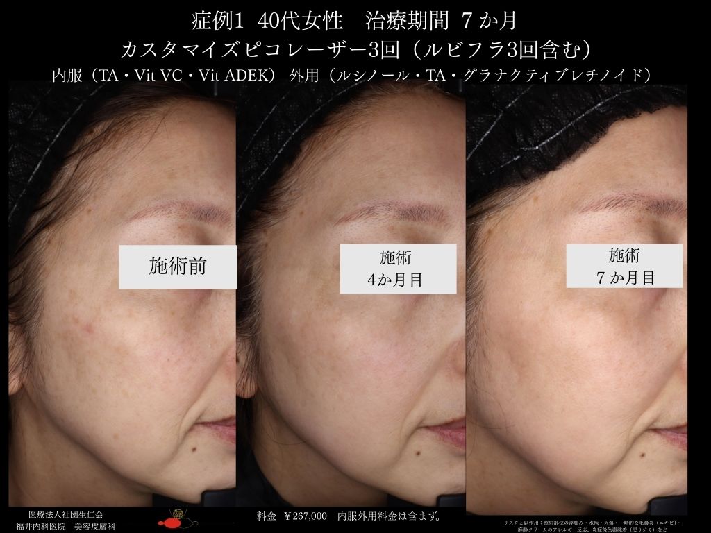 ピコレーザー症例_vol.1_004