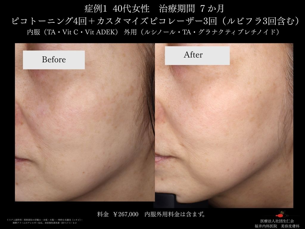 ピコレーザー症例_vol.1_006