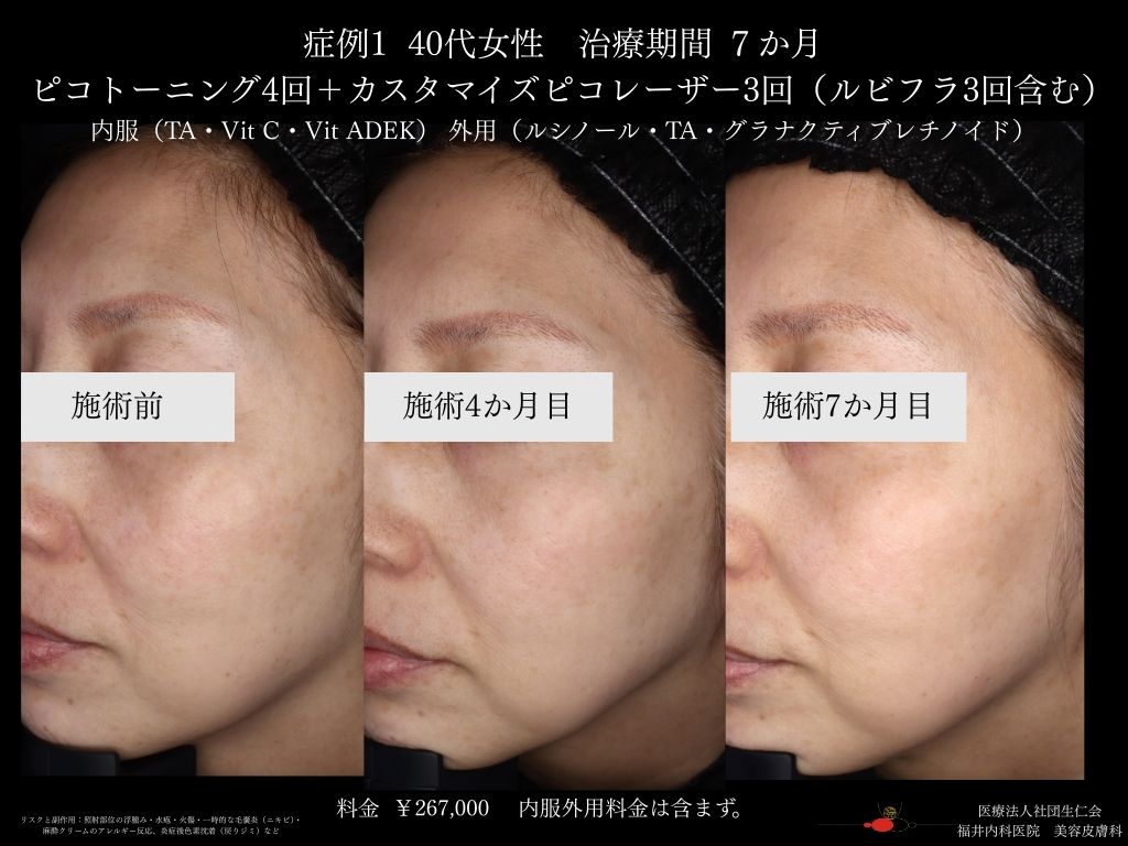 ピコレーザー症例_vol.1_007