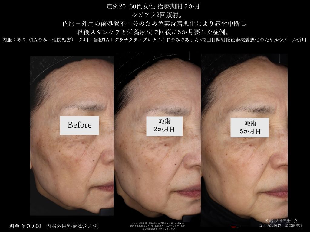 ピコレーザー症例_vol.20_002