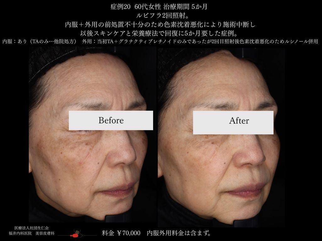 ピコレーザー症例_vol.20_003