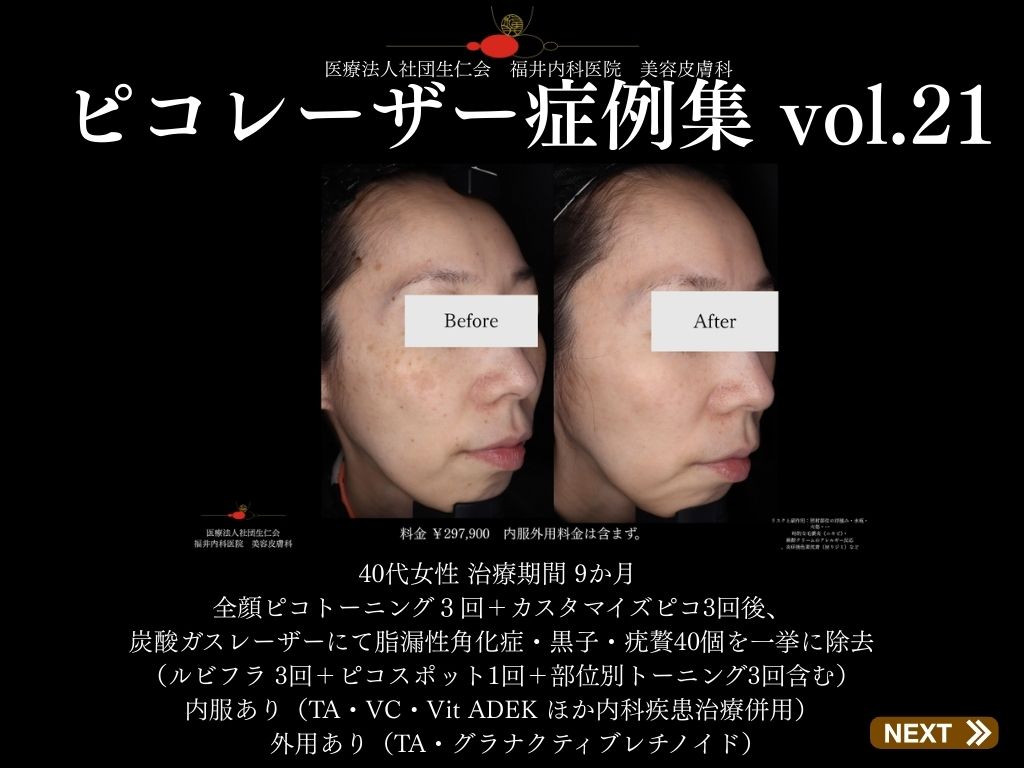 ピコレーザー症例_vol.21_001