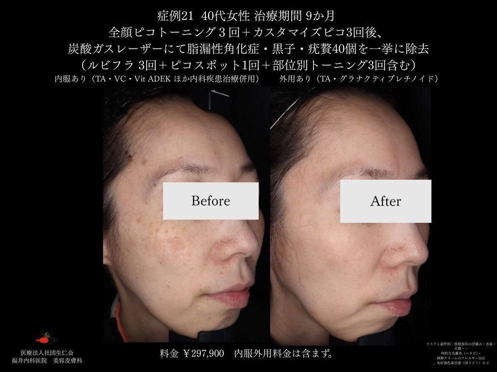 ピコレーザー症例_vol.21_002