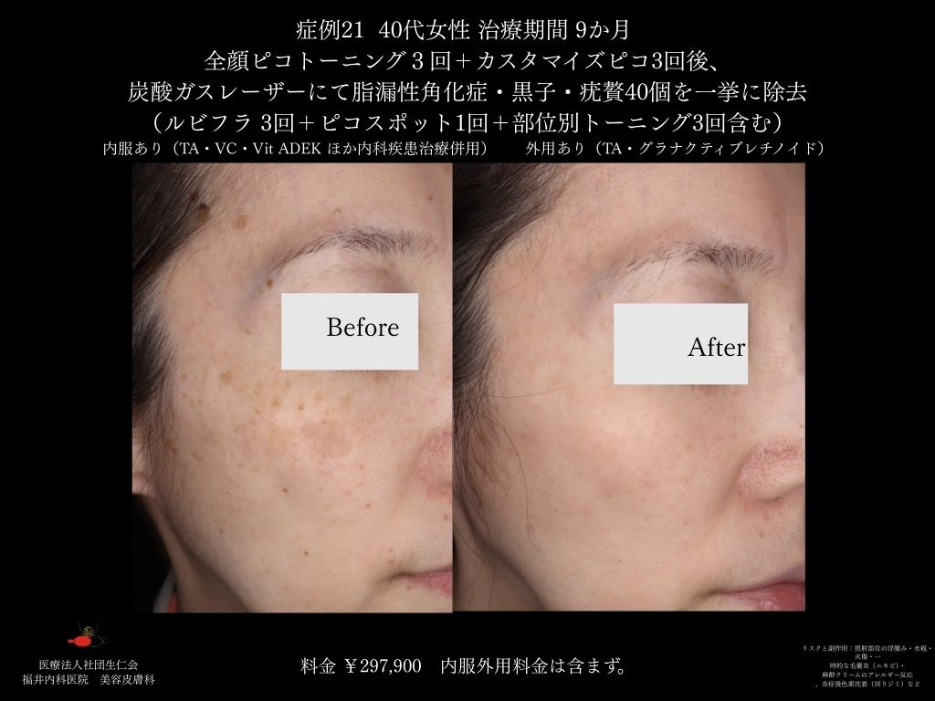 ピコレーザー症例_vol.21_003