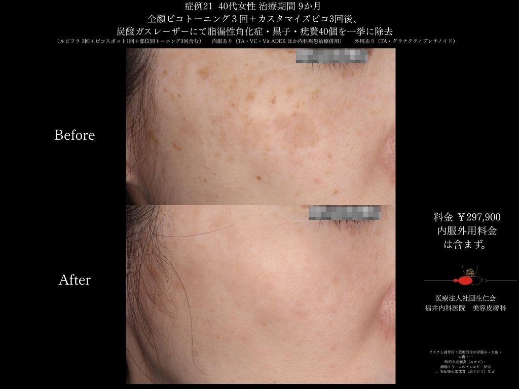 ピコレーザー症例_vol.21_004