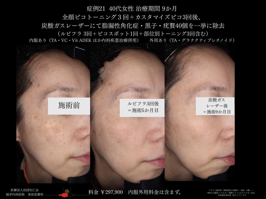 ピコレーザー症例_vol.21_005