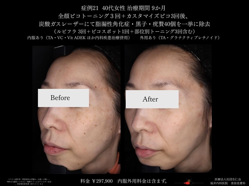 ピコレーザー症例_vol.21_006