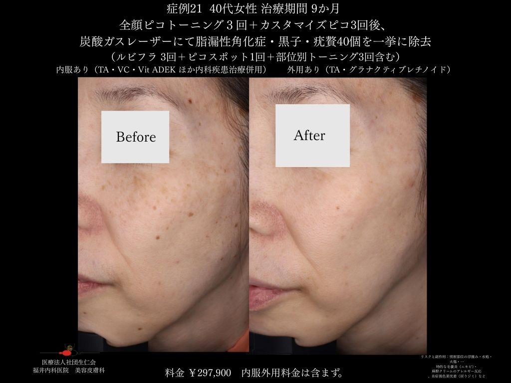 ピコレーザー症例_vol.21_007