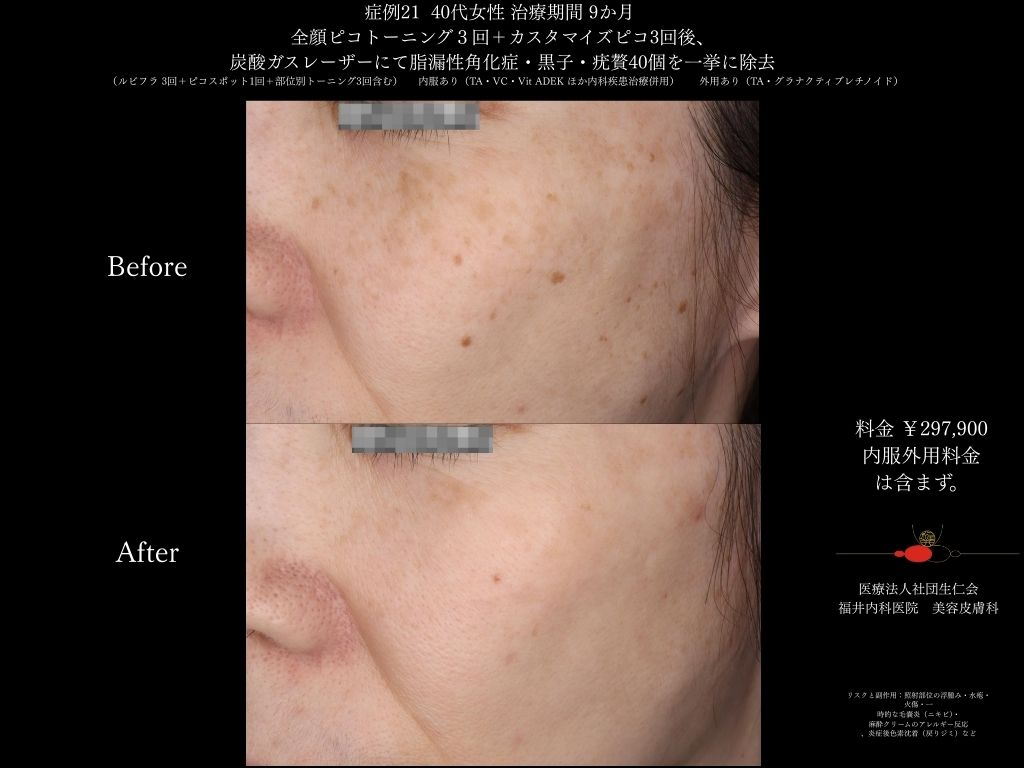 ピコレーザー症例_vol.21_008