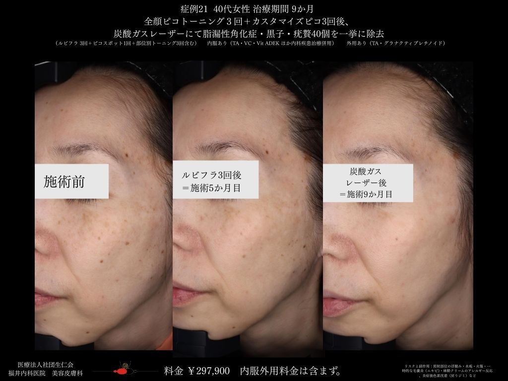 ピコレーザー症例_vol.21_009