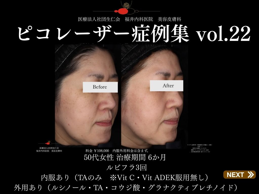 ピコレーザー症例_vol.22_001