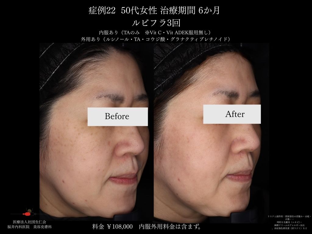 ピコレーザー症例_vol.22_002