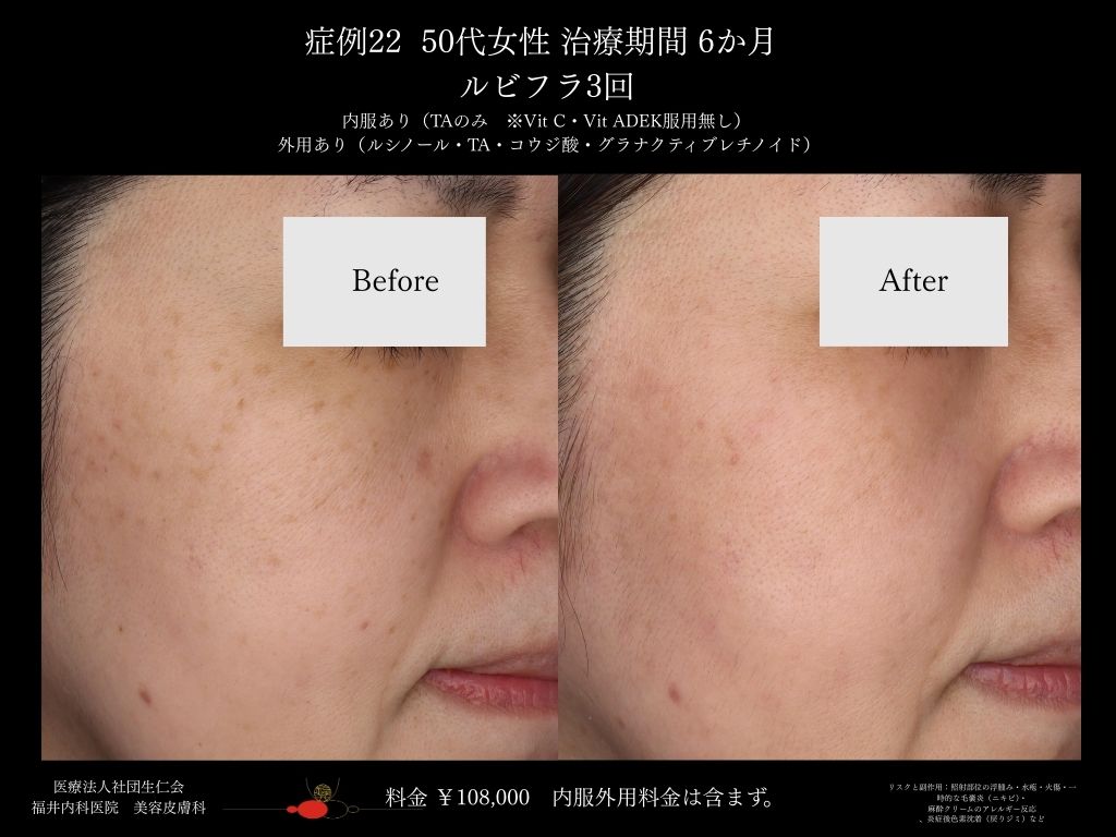 ピコレーザー症例_vol.22_003