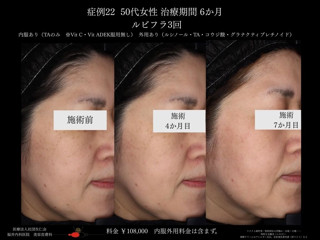 ピコレーザー症例_vol.22_004