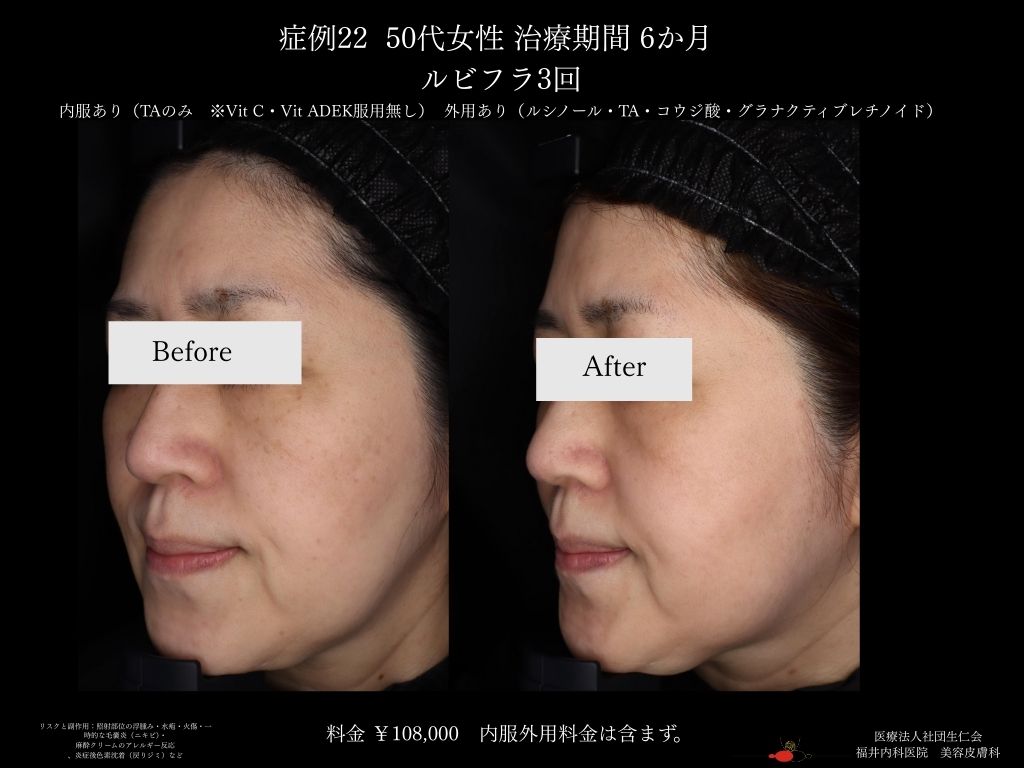 ピコレーザー症例_vol.22_005