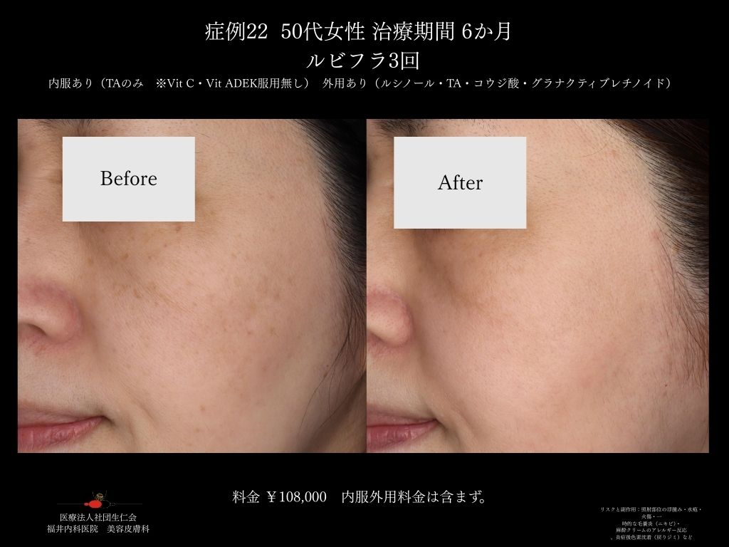 ピコレーザー症例_vol.22_006