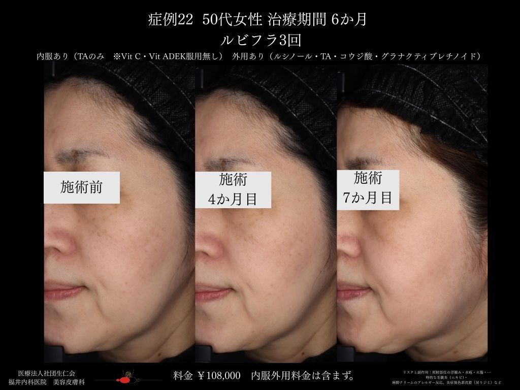 ピコレーザー症例_vol.22_007