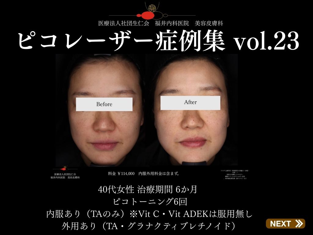 ピコレーザー症例_vol.23_001