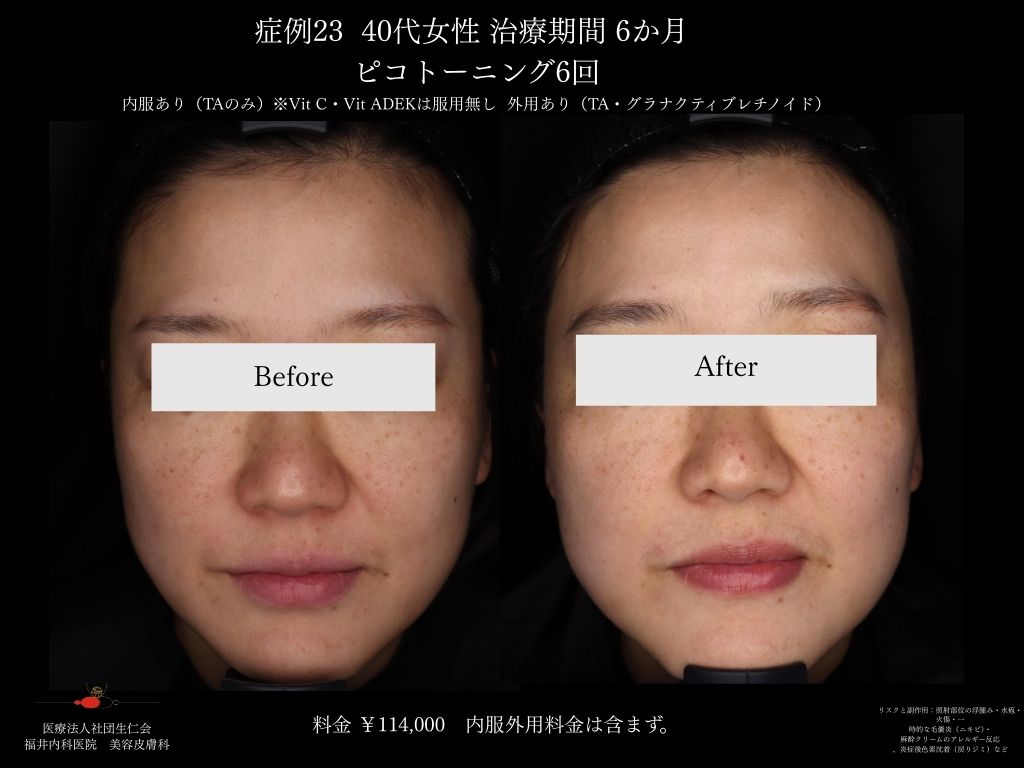 ピコレーザー症例_vol.23_002