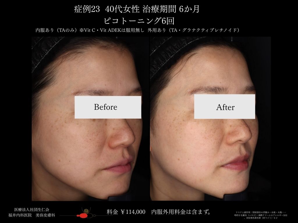 ピコレーザー症例_vol.23_003