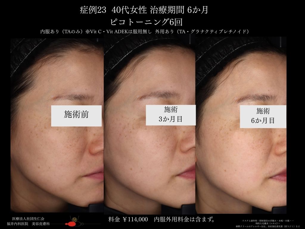 ピコレーザー症例_vol.23_004
