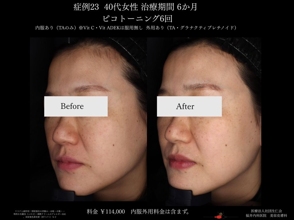 ピコレーザー症例_vol.23_005