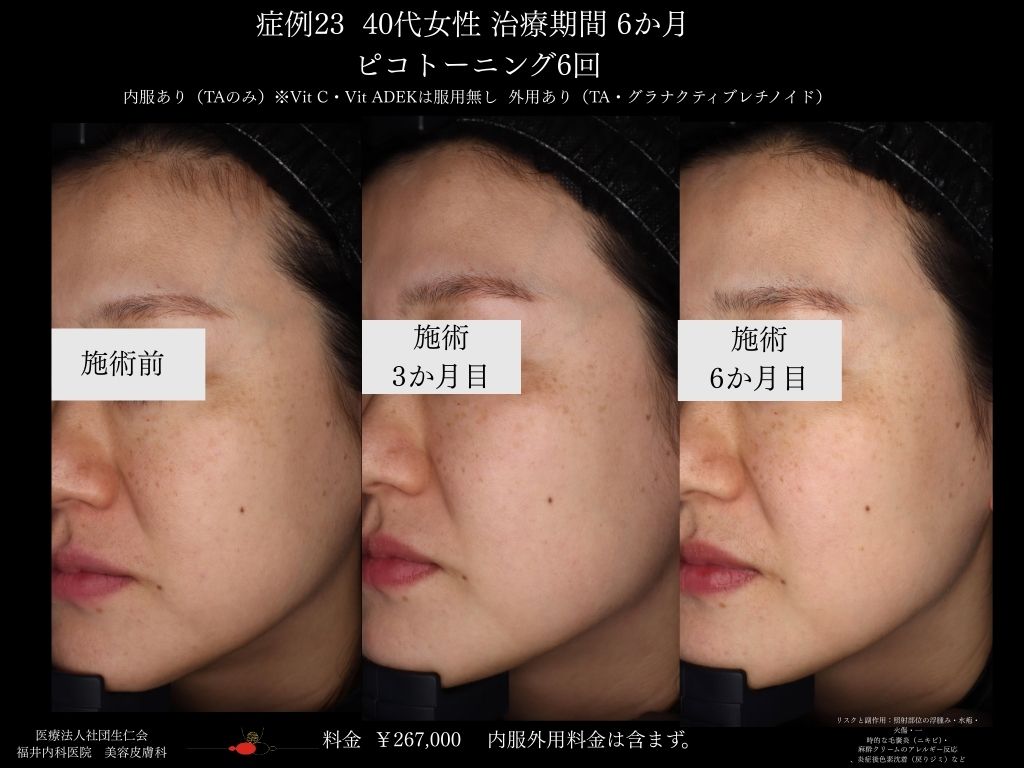 ピコレーザー症例_vol.23_006