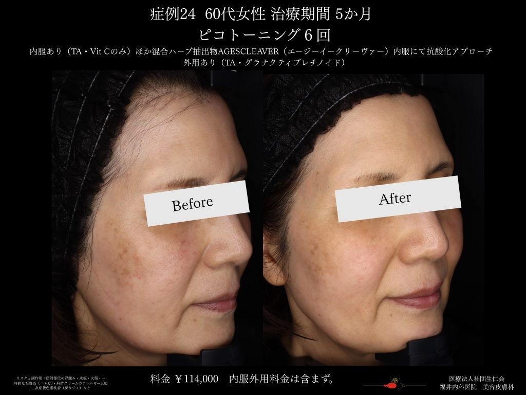 ピコレーザー症例_vol.24_002