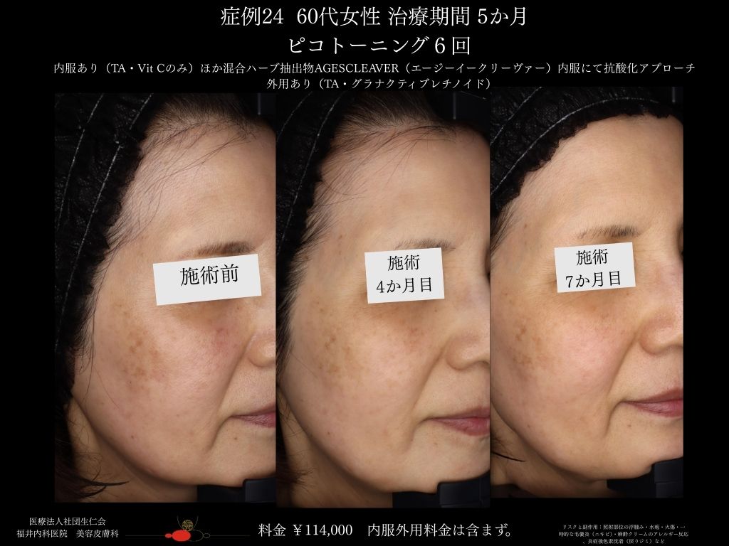 ピコレーザー症例_vol.24_003