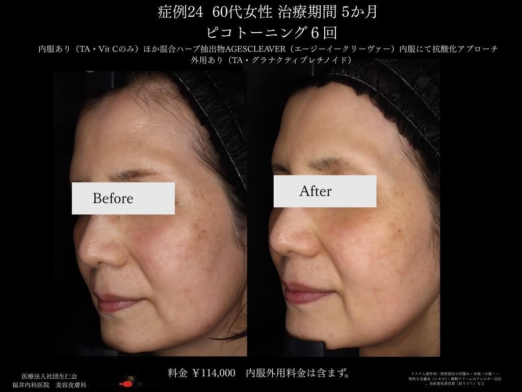 ピコレーザー症例_vol.24_004