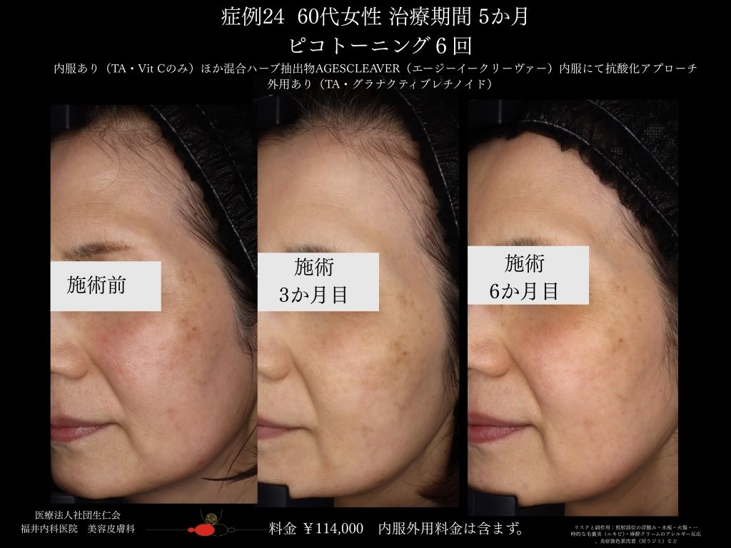 ピコレーザー症例_vol.24_005
