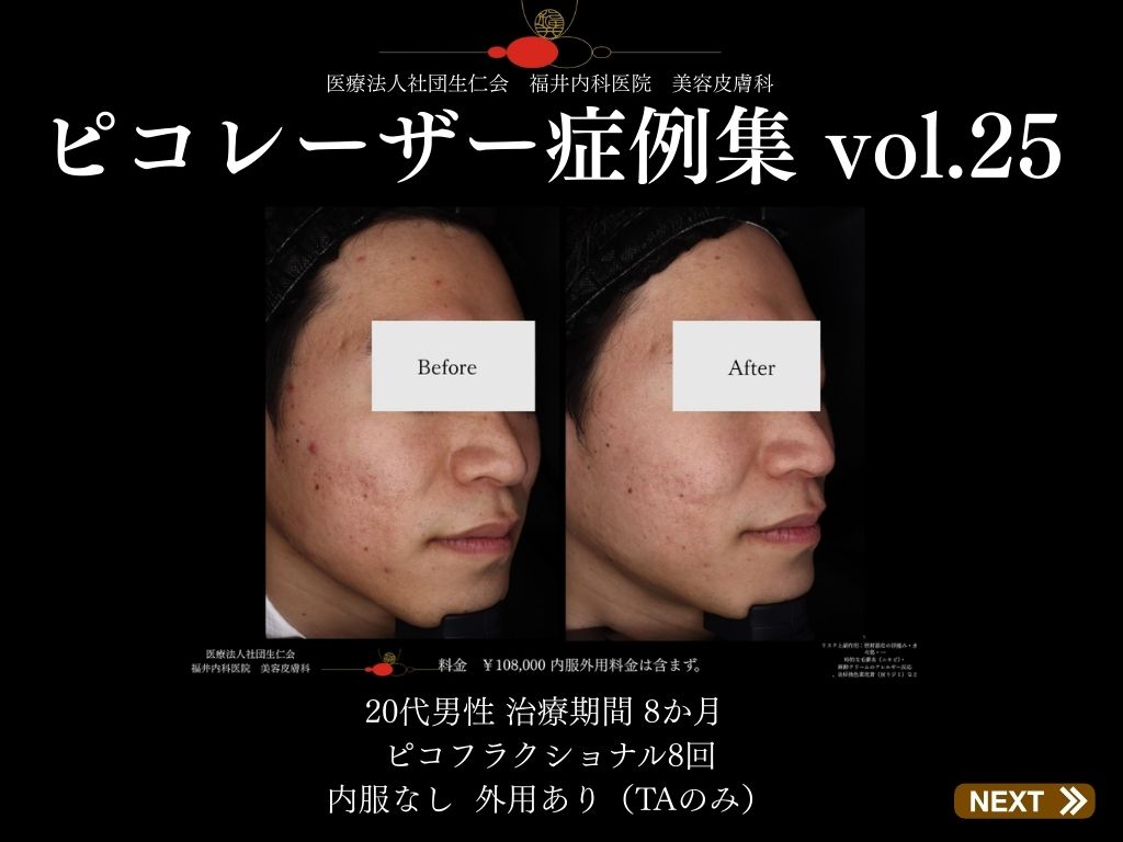 ピコレーザー症例_vol.25_001